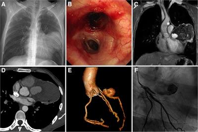 Case report: Multimodality imaging revealing ruptured giant coronary artery aneurysm presenting with hemoptysis